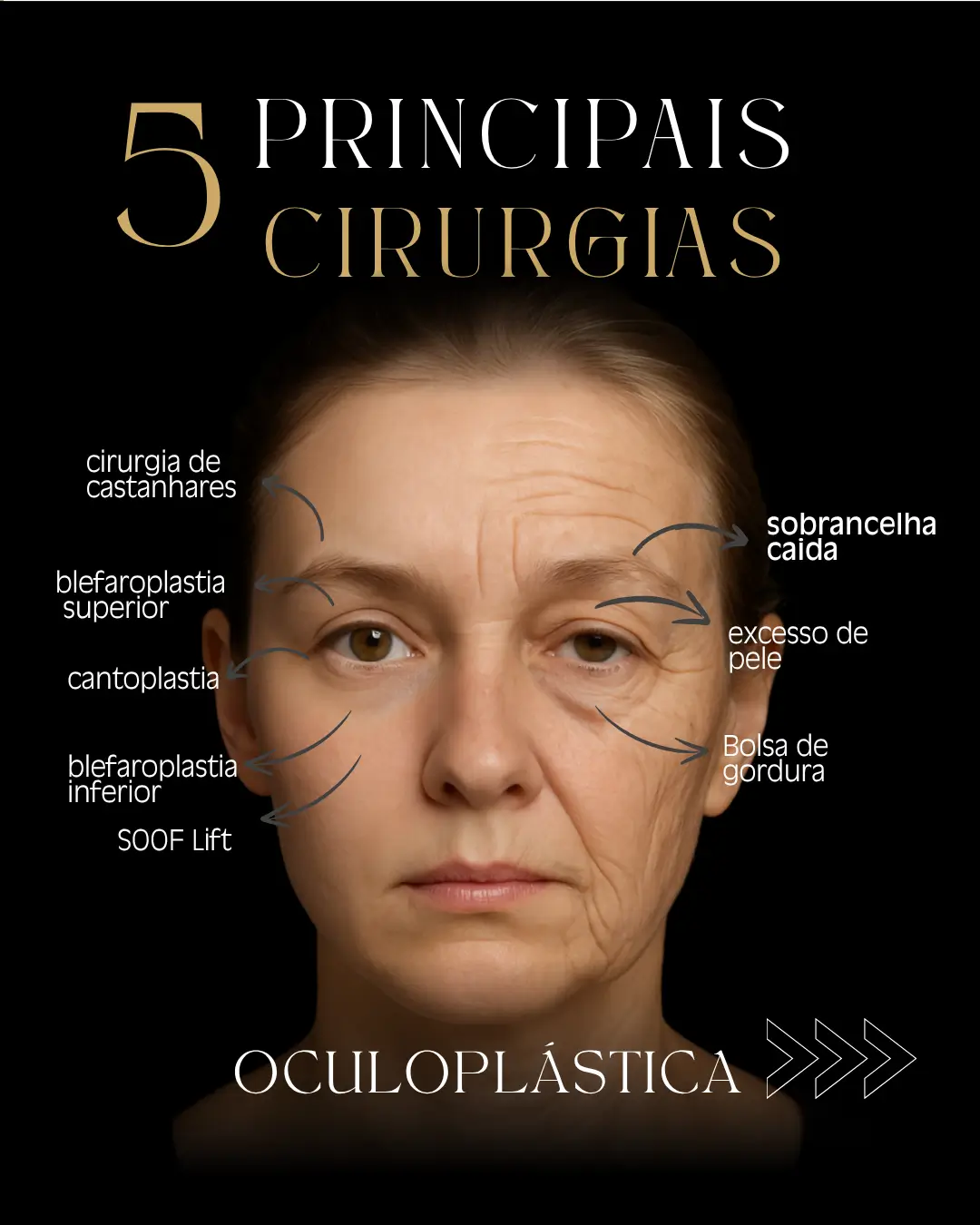 Tipos de cirurgias oculoplásticas em Campinas