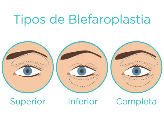 Marcação cirúrgica demonstrando as diferentes áreas de atuação da blefaroplastia