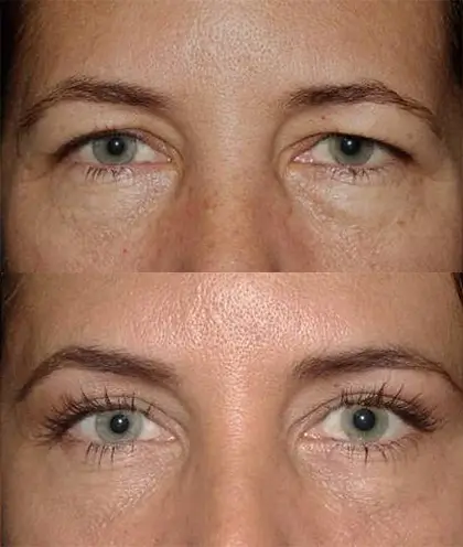 Antes e depois de blefaroplastia superior em Campinas
