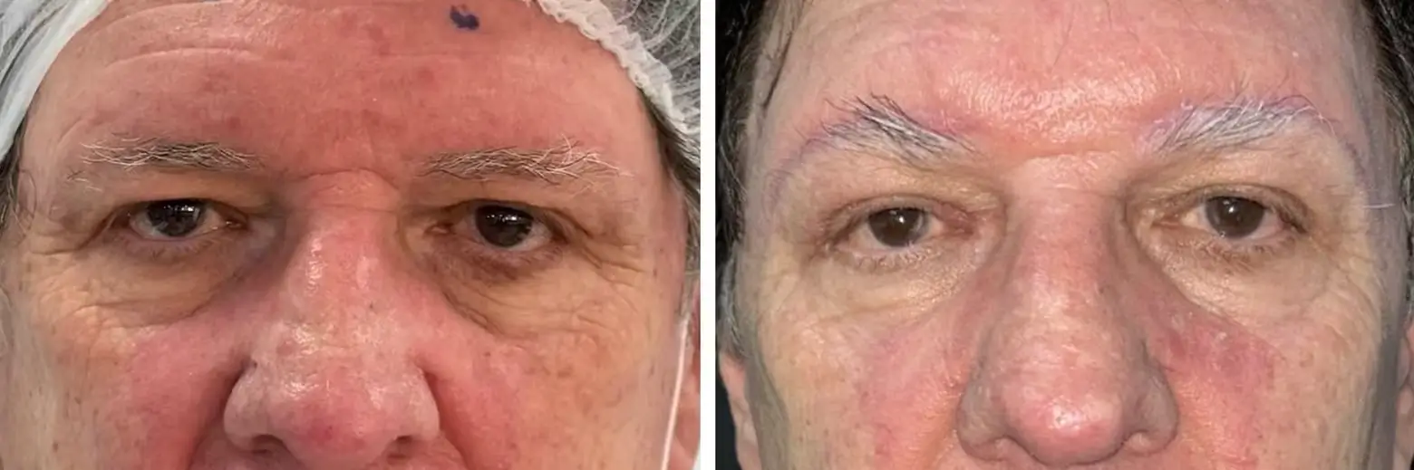 Comparativo de Lifting de Sobrancelha (Castanhares) demonstrando rejuvenescimento sutil do olhar